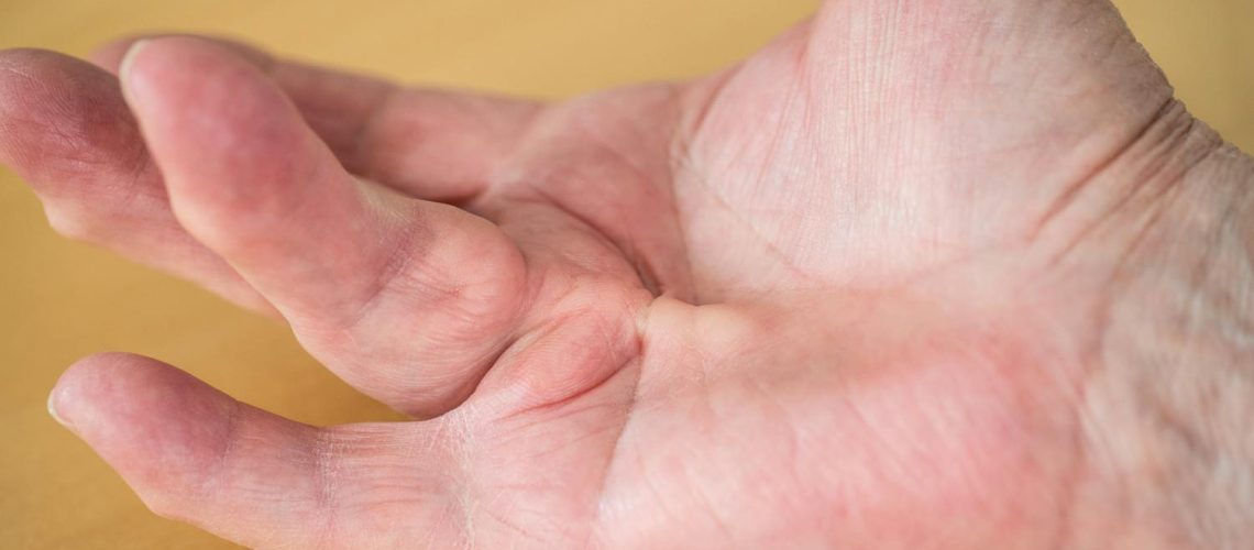 Maladie de Dupuytren : pourquoi cette déformation du doigt ? Maladie de Dupuytren : pourquoi cette déformation du doigt ?